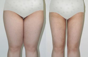 處女膜修復的效果如何？真實回答揭曉