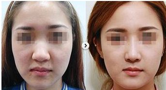 福州隆美爾整形高口碑揭秘：實力醫(yī)生團(tuán)隊打造逆齡容顏